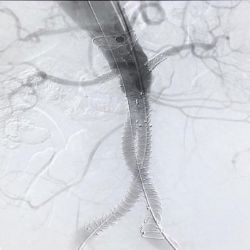 Primer implante realizado con éxito en España de Anaconda™ Fenestrada con fenestración entre los anillos en el Hospital Universitario de la Paz