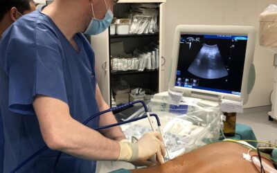 El Hospital Universitario de Burgos trata tumores renales de difícil acceso mediante crioablación