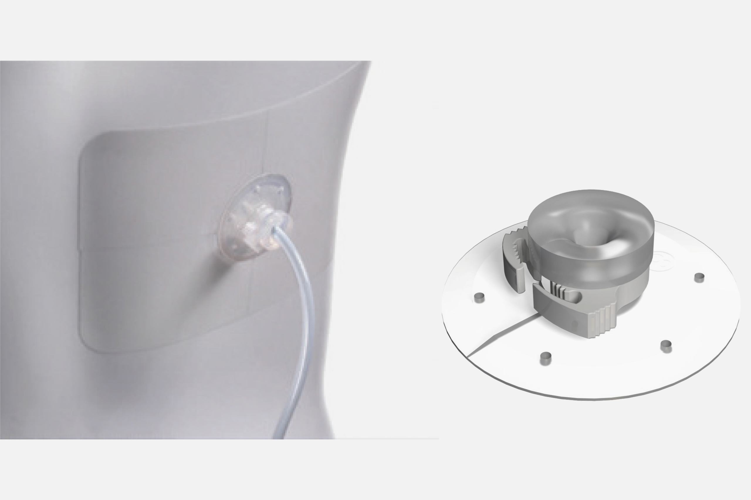 Kit de fijación de catéter: TRU-FIX™