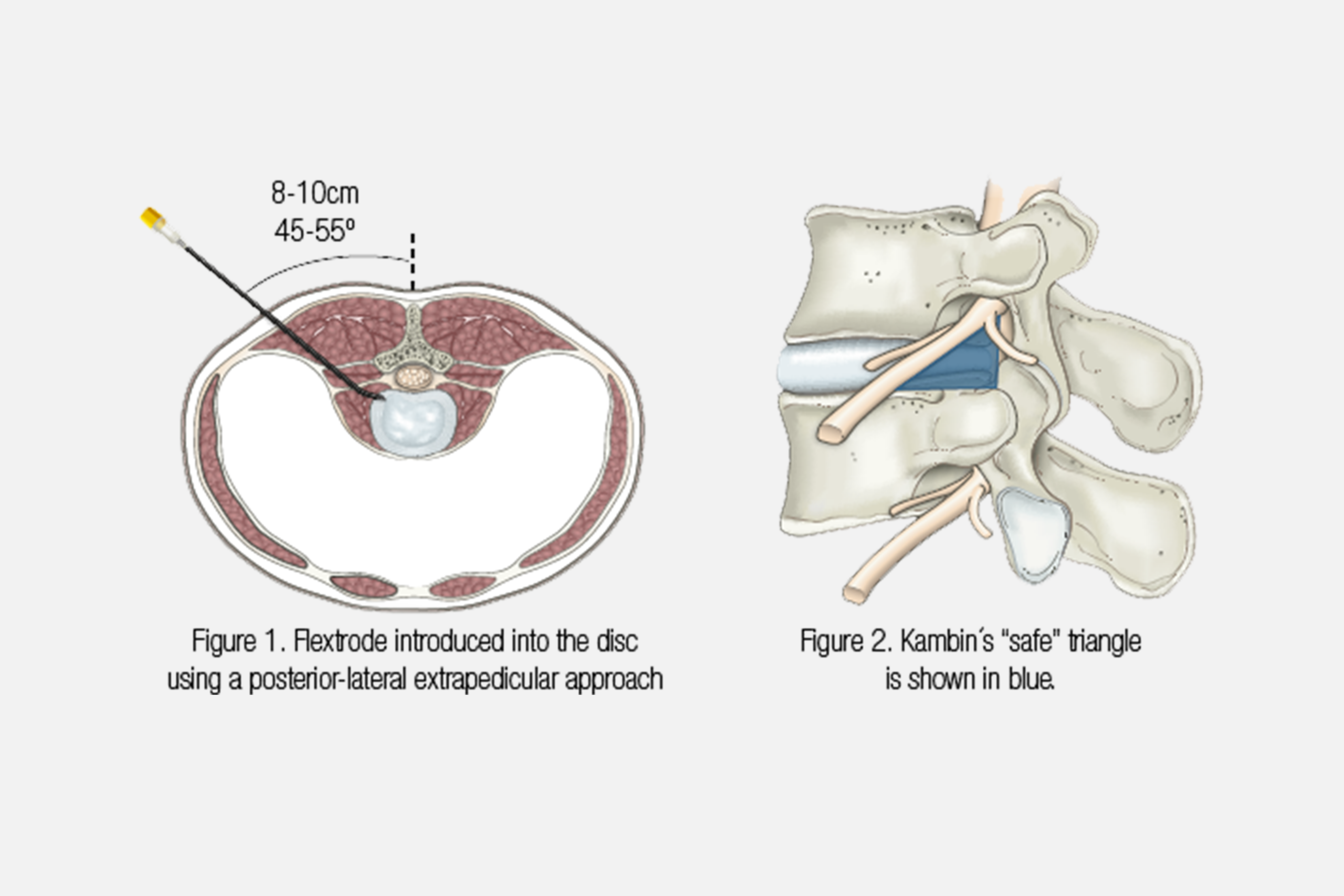FLEXTRODE - Imagen 2